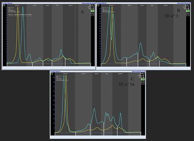 Urinary phoretograms performed by capillary electrophoresis in dogs with chronic disease with or without Leishmania infantum infection